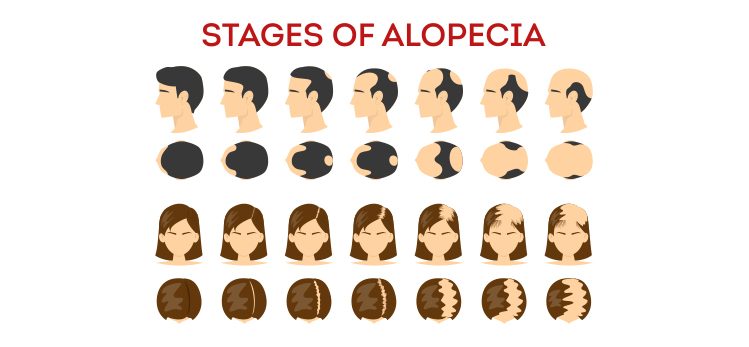 alopecia-stages-set-hair-loss-balding