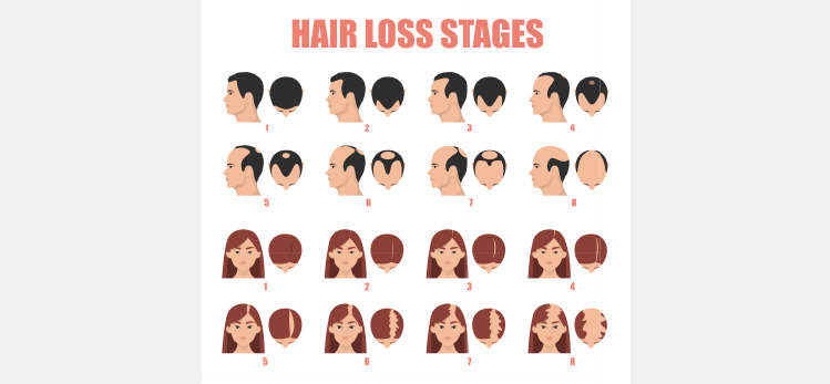 hair-loss-stages-vector-isolated