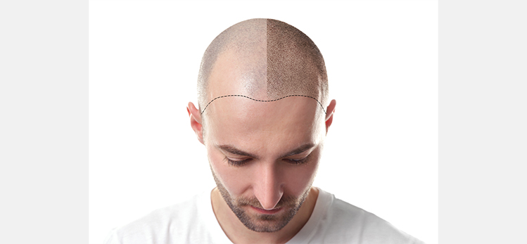 man-before-after-hair-loss