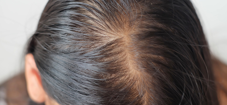 close-thin-hair-on-scalp-head