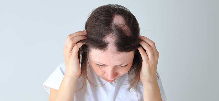 real-alopecia-areata-young-girl-bald