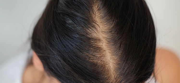 close-woman-hair-on-her-foreheadhormone
