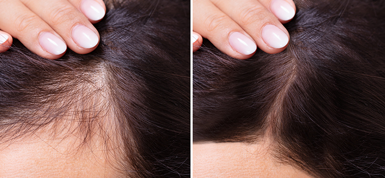 woman-before-after-hair-loss-treatment