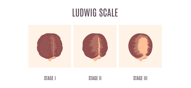 femalepattern-hair-loss-by-ludwig-scale