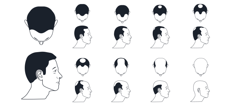 male-baldness-types-norwood-scale-bald