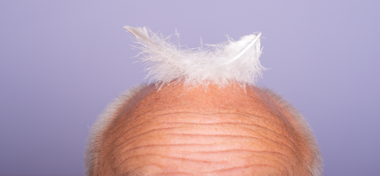 hairtreatment-hairloss-concept-senior-bald