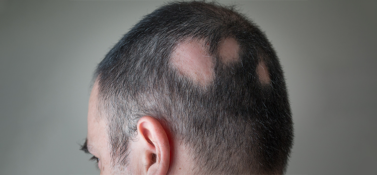 alopecia-aerata-spot-baldness