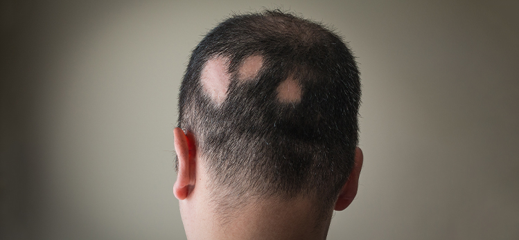 alopecia-aerata