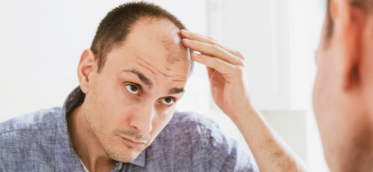 male-pattern-hair-loss-problem-concept