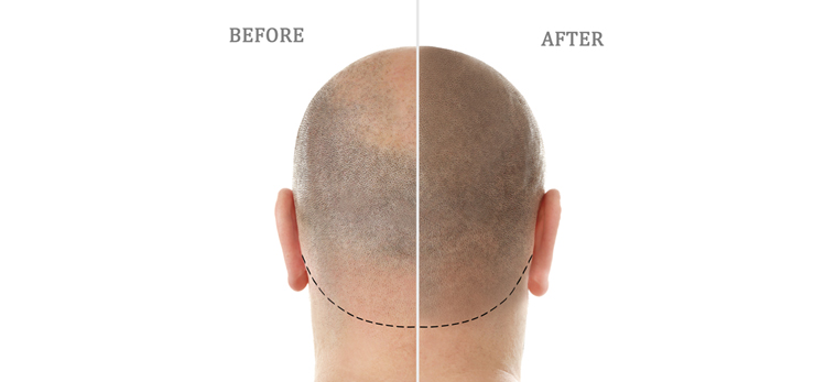 3 Ways to Treat Male Pattern Baldness - Mintop Hair