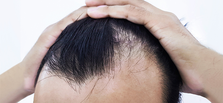 Minoxidil For Men - Everything You Need To Know