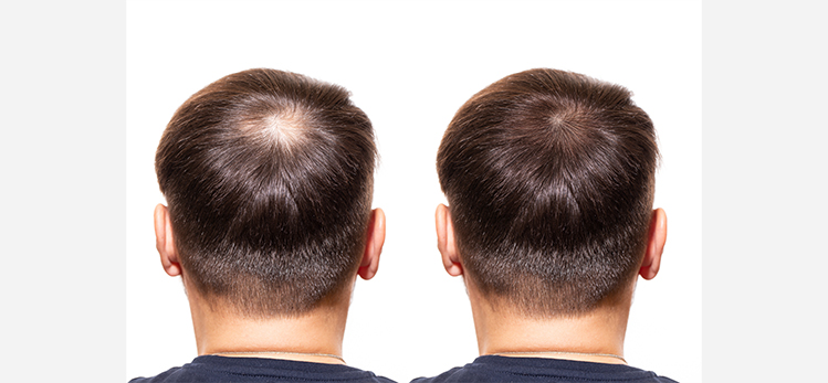 What-Are-The-Types-Of-Hair-Loss/hair-loss-care-concept-transplantation