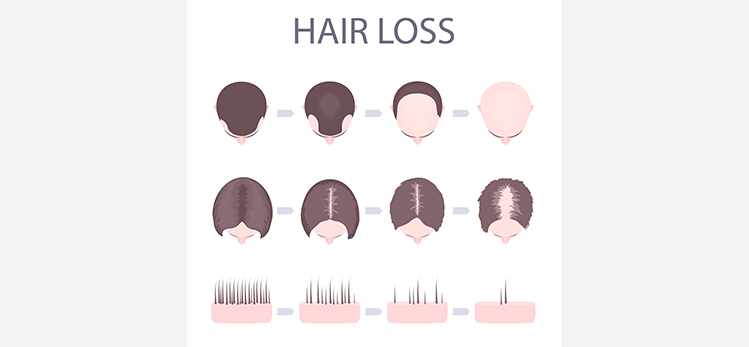 male-female-pattern-hair-loss