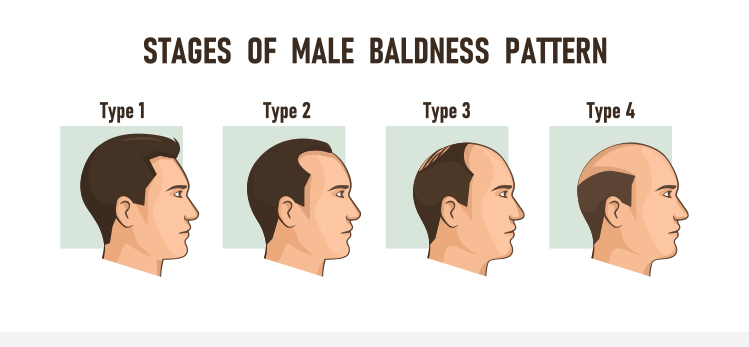 stages-male-baldness-pattern