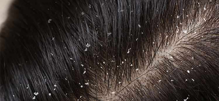Details more than 67 dandruff and hair loss super hot