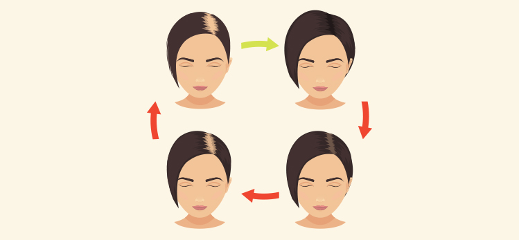 female-hair-loss-stages-set-woman