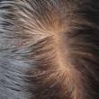 Female-Pattern-Baldness