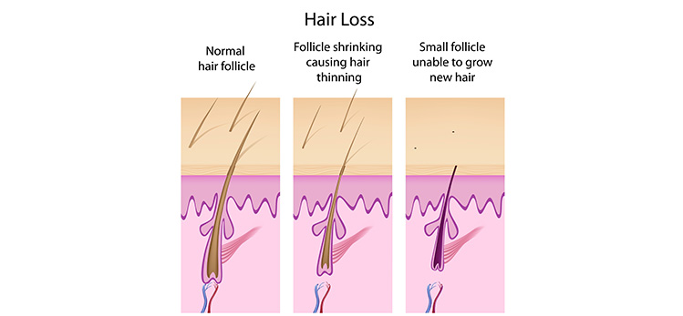Hair fall due to hormonal imbalance
